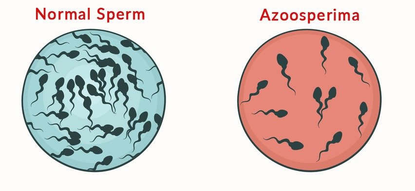 azoospermia sperm