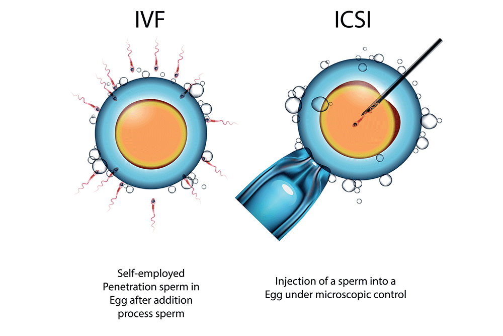 IVF vs ICSI
