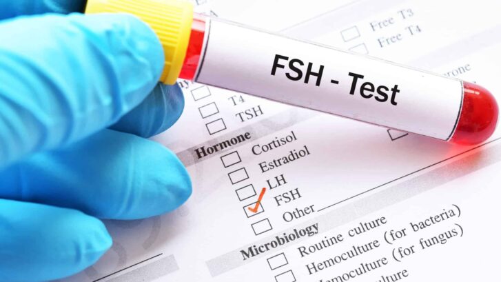 FSH Test