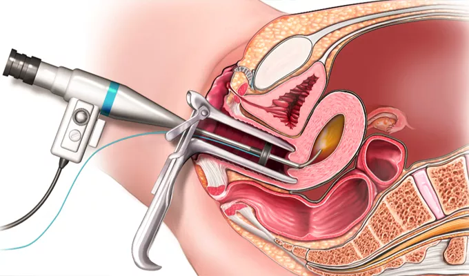 Hysteroscopy Indications