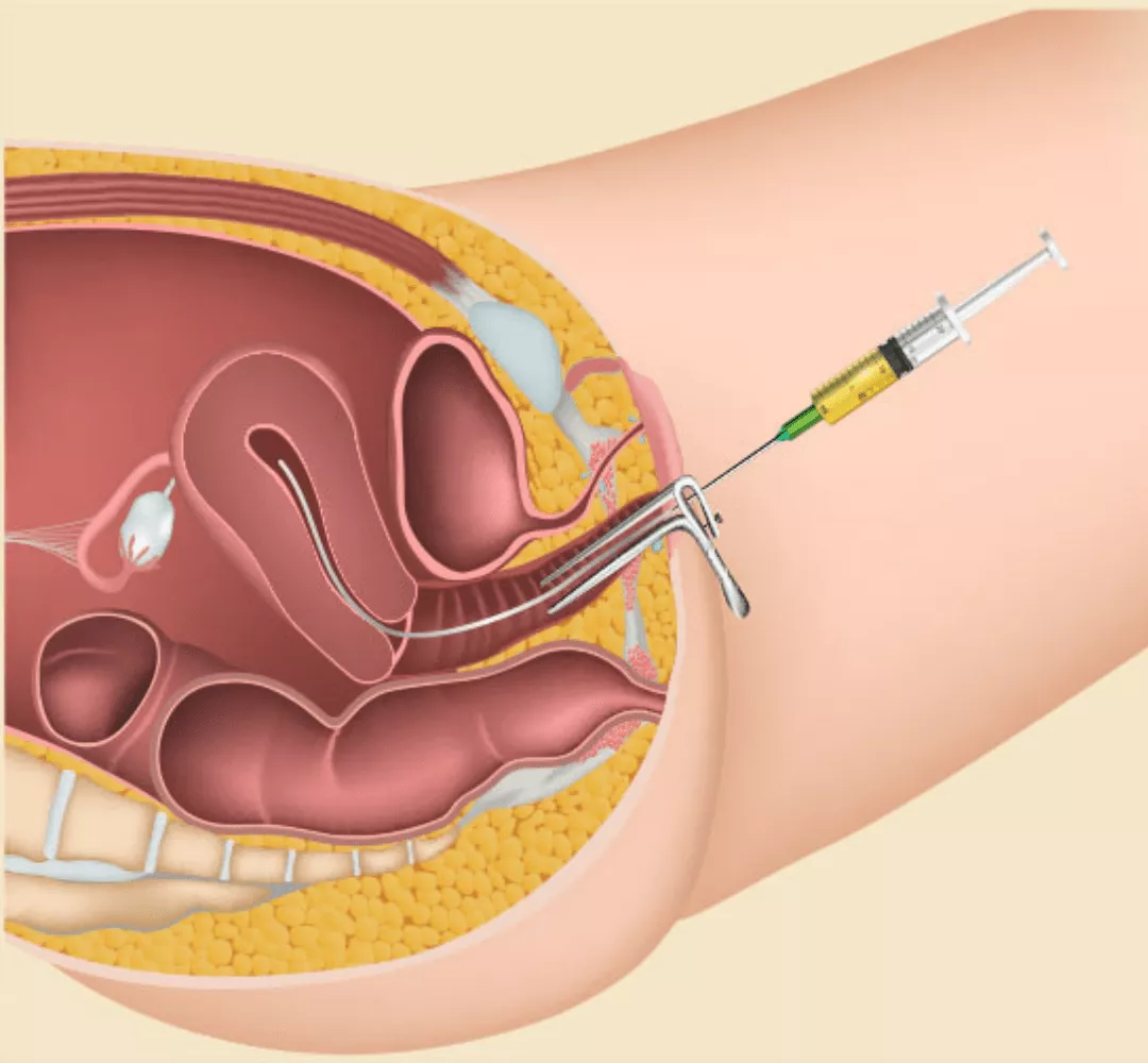 IUI (Intrauterine Insemination)